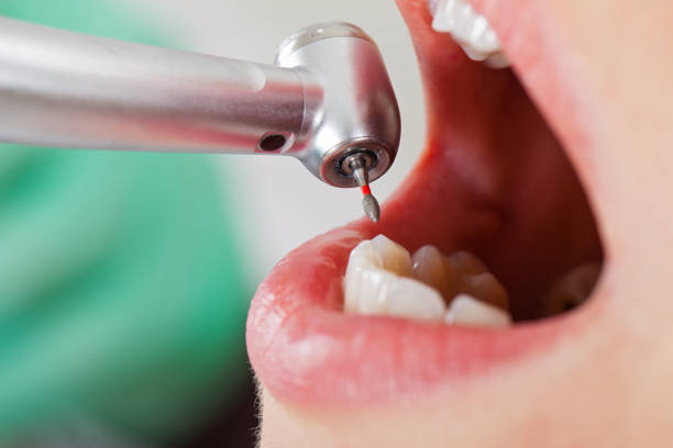 Best Urgent Tooth Repair  in Cedaredge, CO